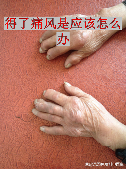 风湿 痛风是一回事吗