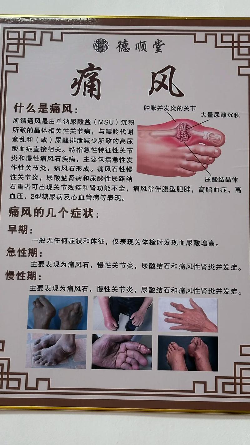 风湿 痛风是一回事吗