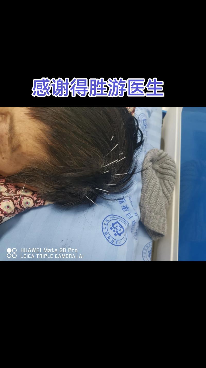 龙华医院 脑梗 针灸