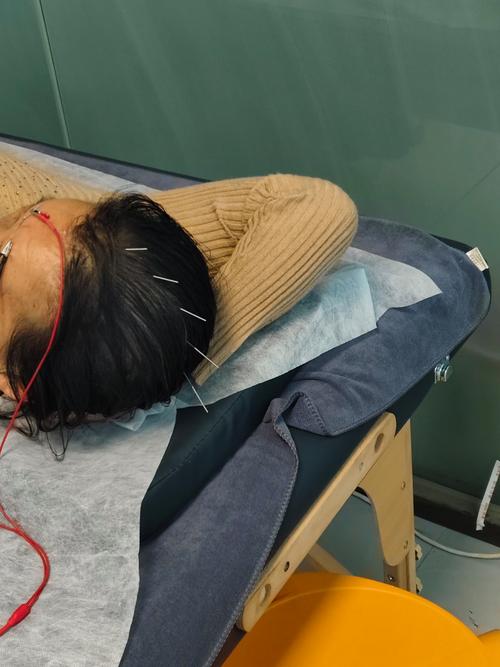 龙华医院 脑梗 针灸