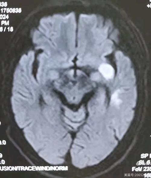 脑梗能做脑核磁共振吗