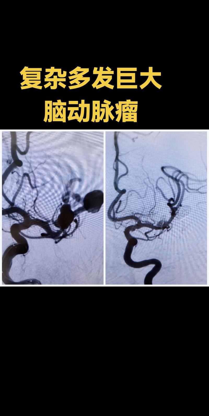 急性脑梗发现脑动脉瘤