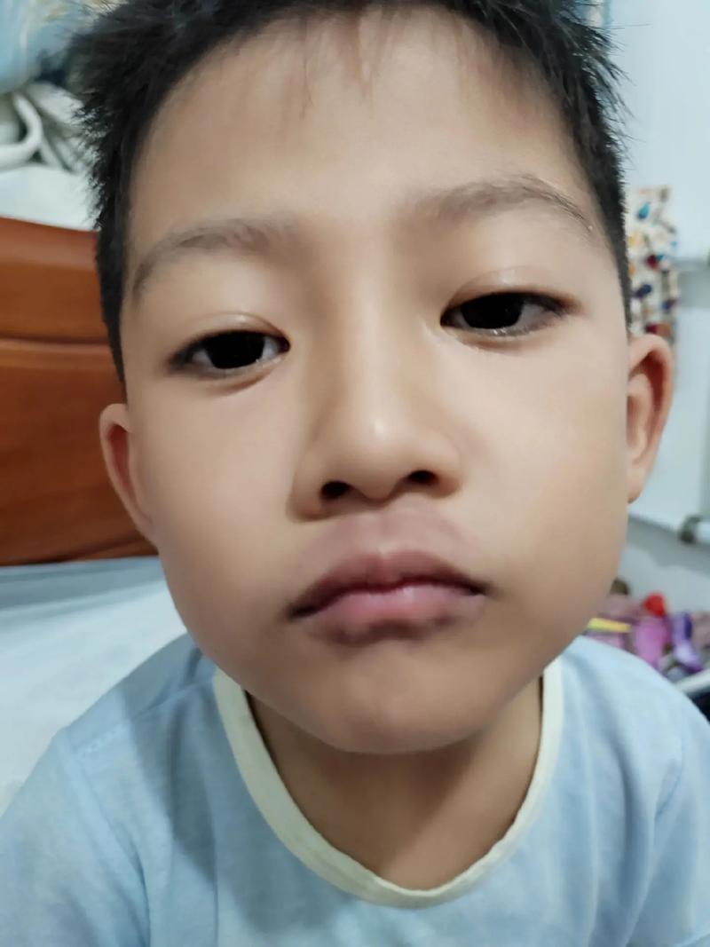 脑梗 睡觉 嘴唇发紫