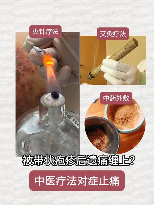 带状疱疹艾灸什么穴位