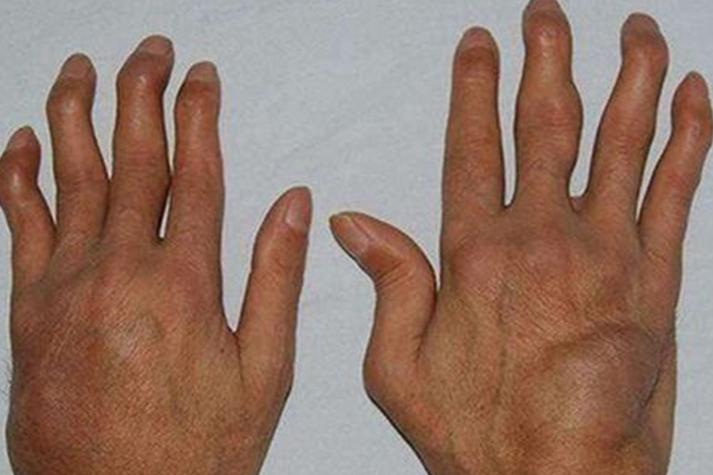 类风湿一个月关节畸形