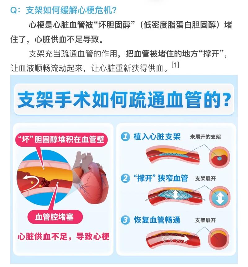 脑梗 支架手术 医保