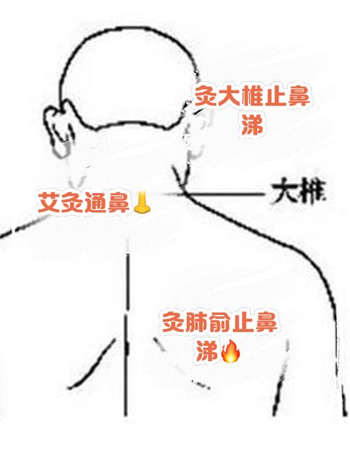小儿鼻炎艾灸哪个穴位