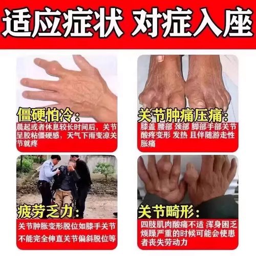 风湿性关节炎用药疗程