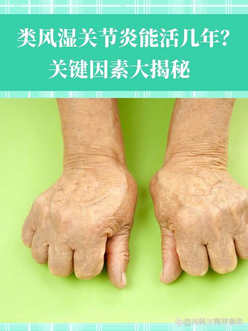 类风湿性关节炎 基因