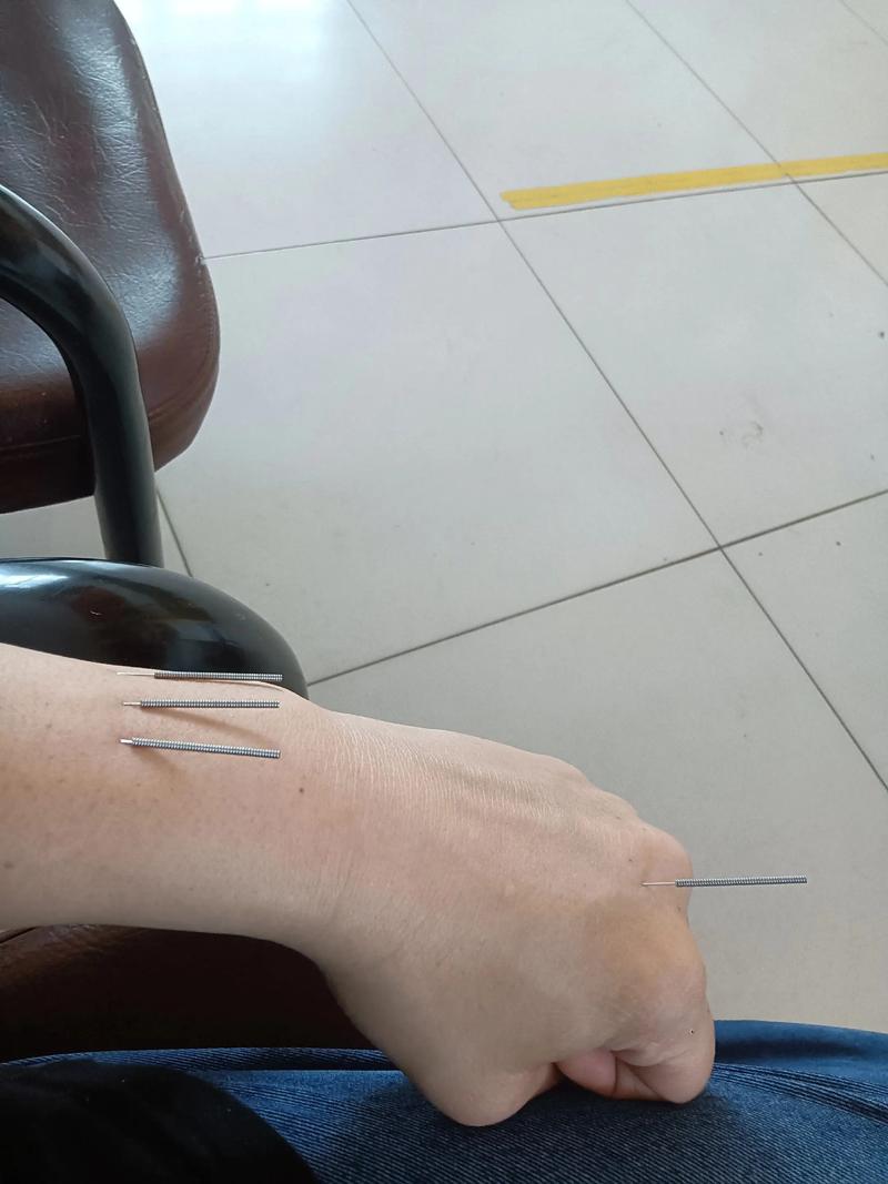 脑梗腔梗针灸效果如何