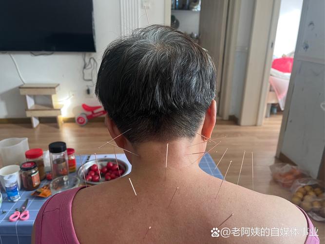 脑梗腔梗针灸效果如何