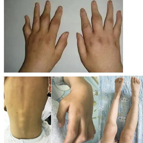 幼儿特发类风湿关节炎
