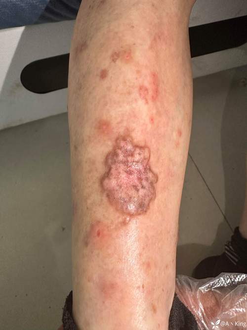 风湿病中纤维素样坏死