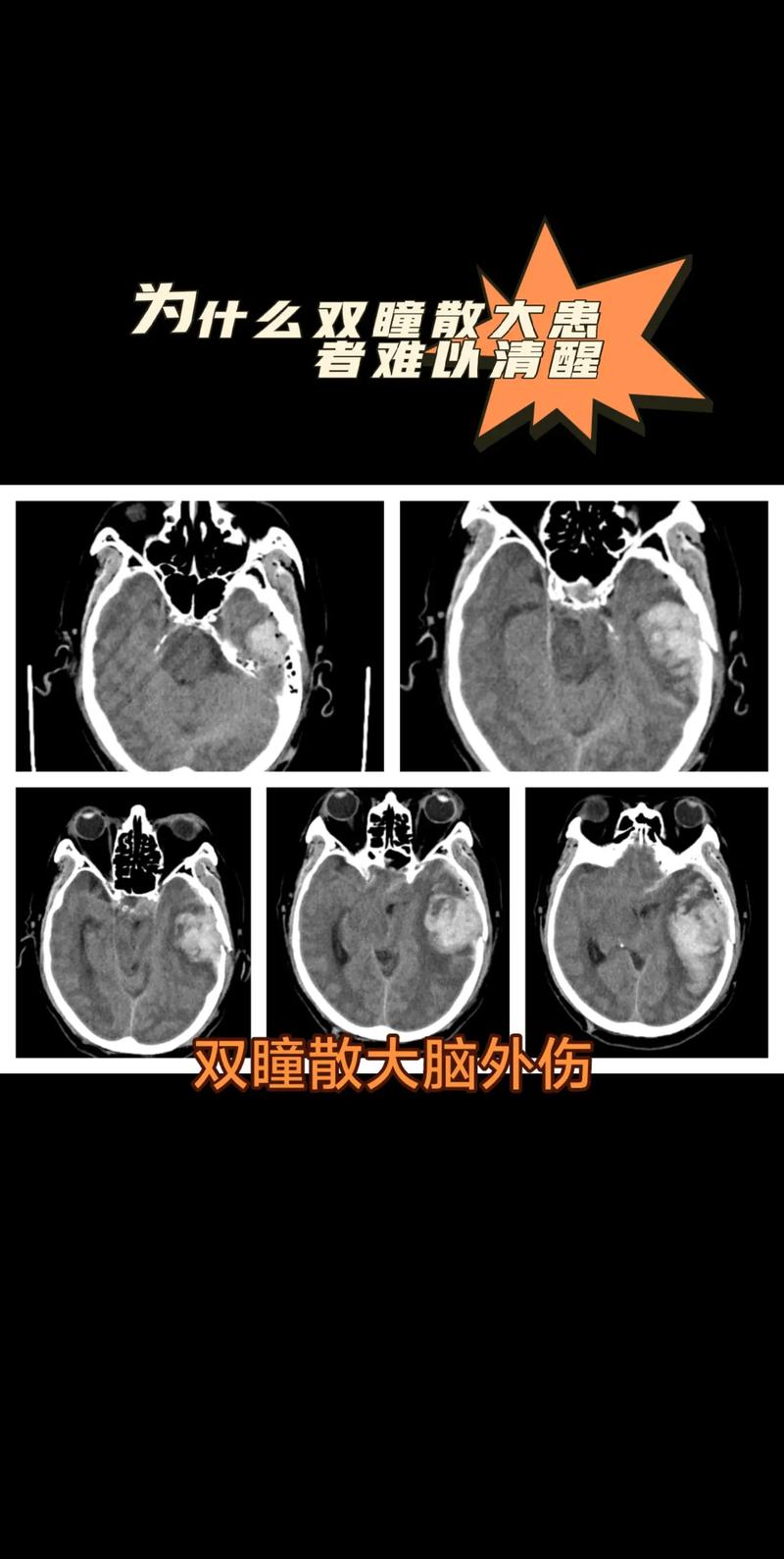 脑内水肿脑梗瞳孔放大