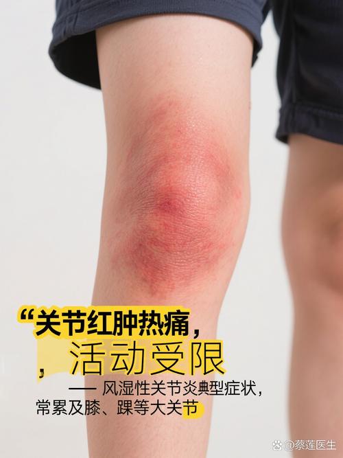 风湿性关节炎关节表现