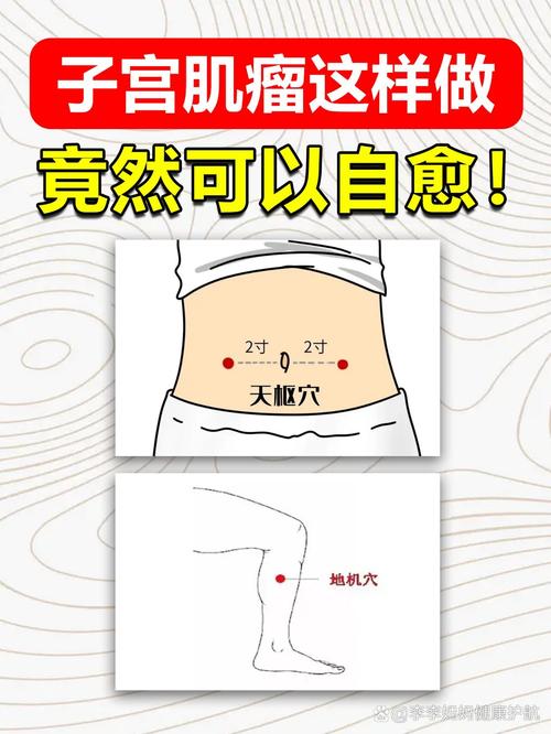 子宫肌瘤艾灸什么穴位