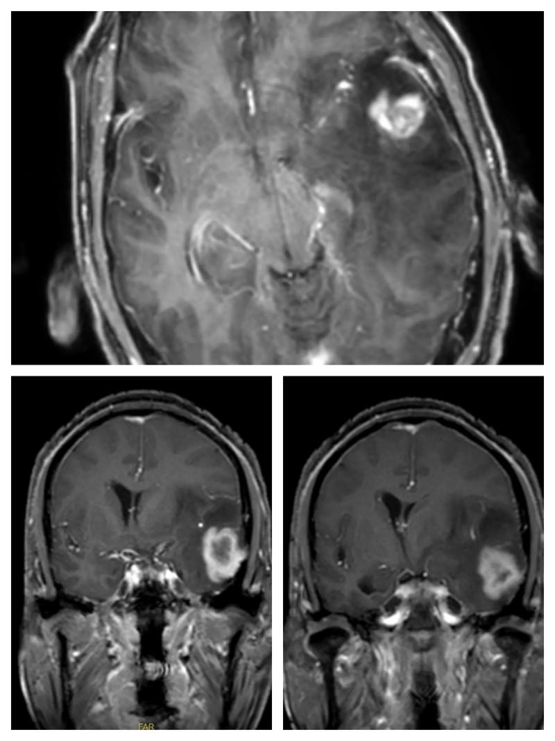 脑磁共振能排除脑梗吗
