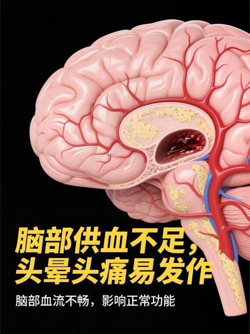 脑供血不足导致的脑梗
