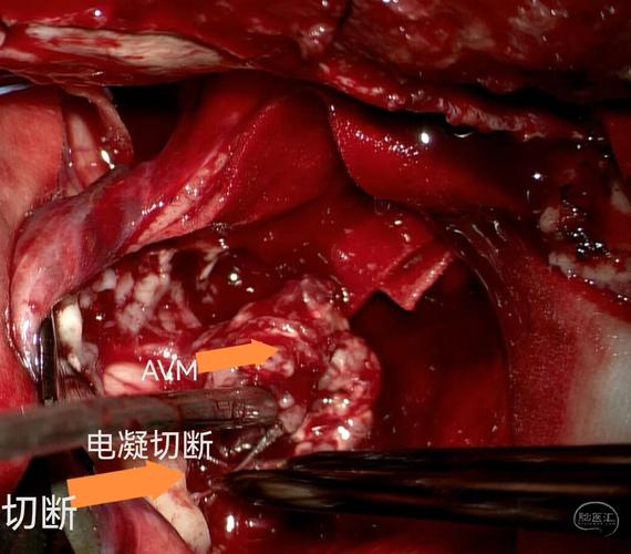 脑梗成脑疝前手术开颅