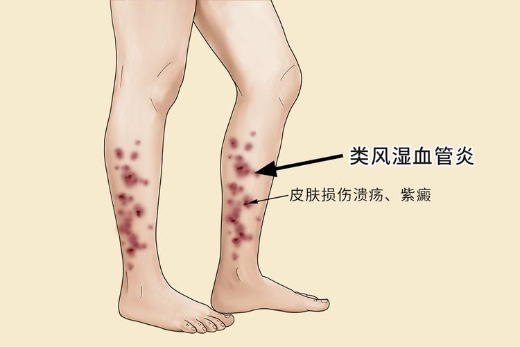 风湿性血管炎能活多久