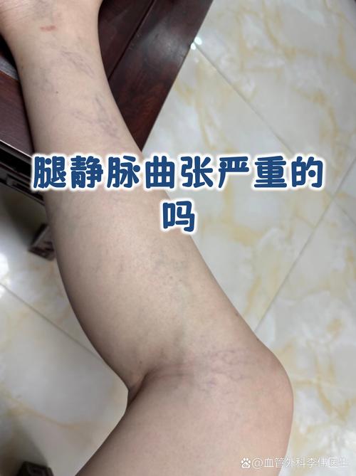 风湿性血管炎能活多久