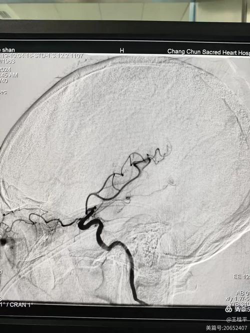 脑梗加左脑动血管堵塞