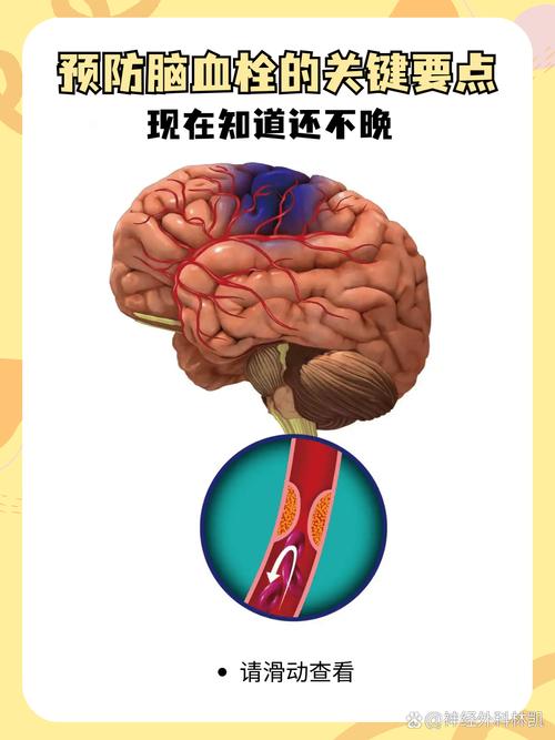 脑梗加左脑动血管堵塞