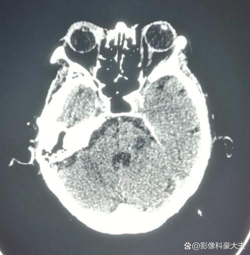 脑ct正常可能脑梗吗
