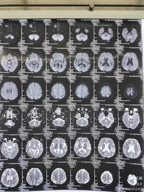 脑内发现多处脑梗病灶