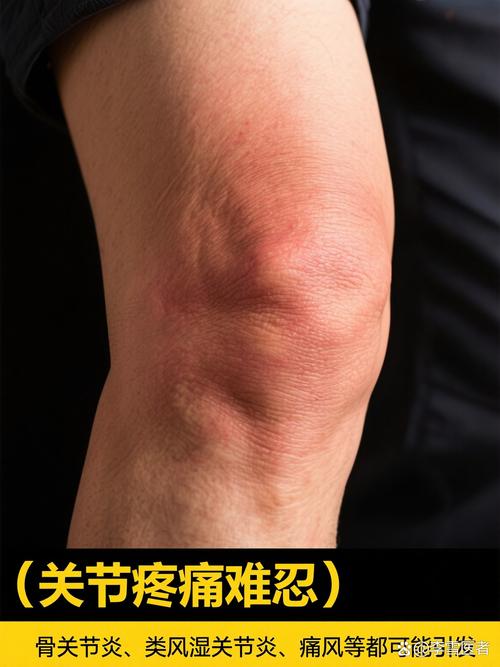 关节疼风湿三项抗o高