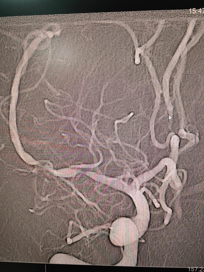 心梗加脑梗 不能支架