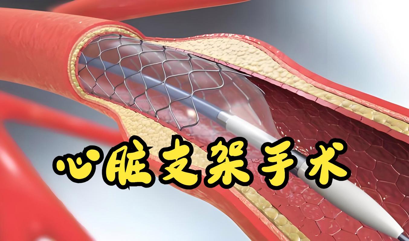 脑梗后心梗可以做支架