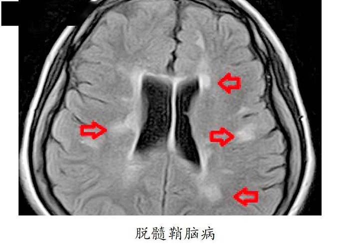 脑白质脱髓鞘导致脑梗