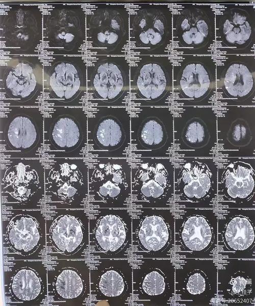 脑ct查出脑梗是什么