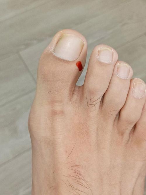 缓解中风放血的穴位