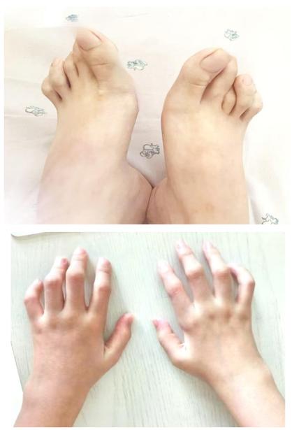 小孩会得风湿性关节炎