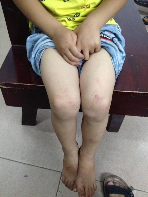 小孩会得风湿性关节炎