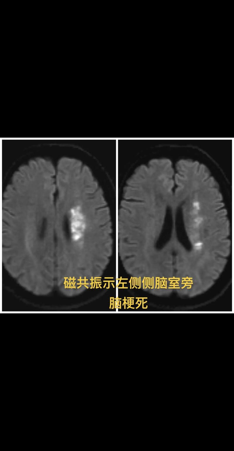 腔梗轻微脑梗 脑损伤