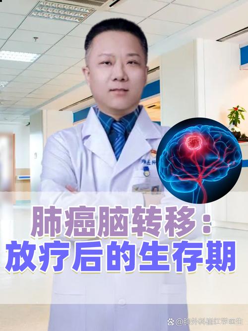 脑梗误诊为肺癌脑转移