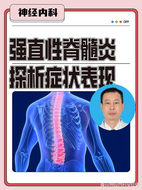 强制性脊柱炎有风湿吗