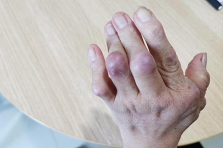 轻度风湿性关节炎症状