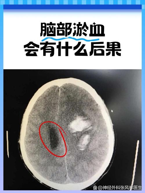 脑梗脑淤血有什么症状