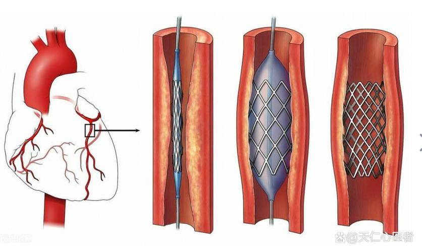 同时心梗脑梗搭桥手术