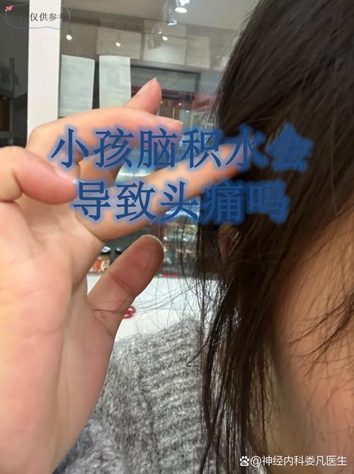 脑梗脑出现脑水肿现象