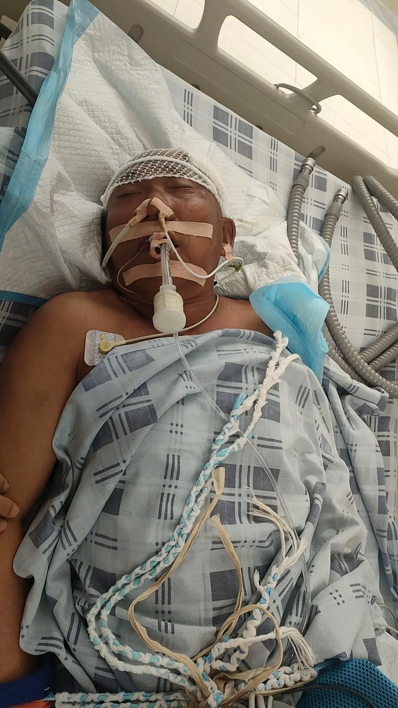 中风脑梗半脑坏死开颅