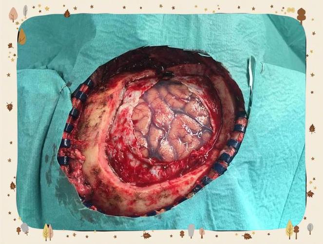 中风脑梗半脑坏死开颅