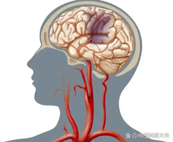 心肌梗和脑梗哪个严重