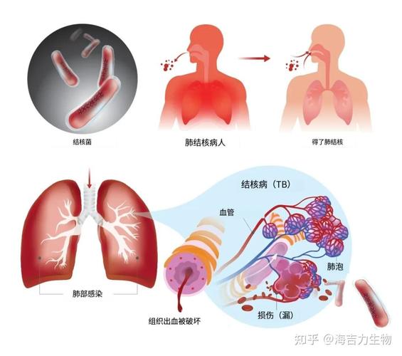 风湿性肺结核是什么样
