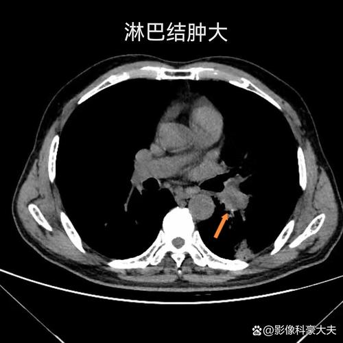 脑CT做了会有脑梗吗