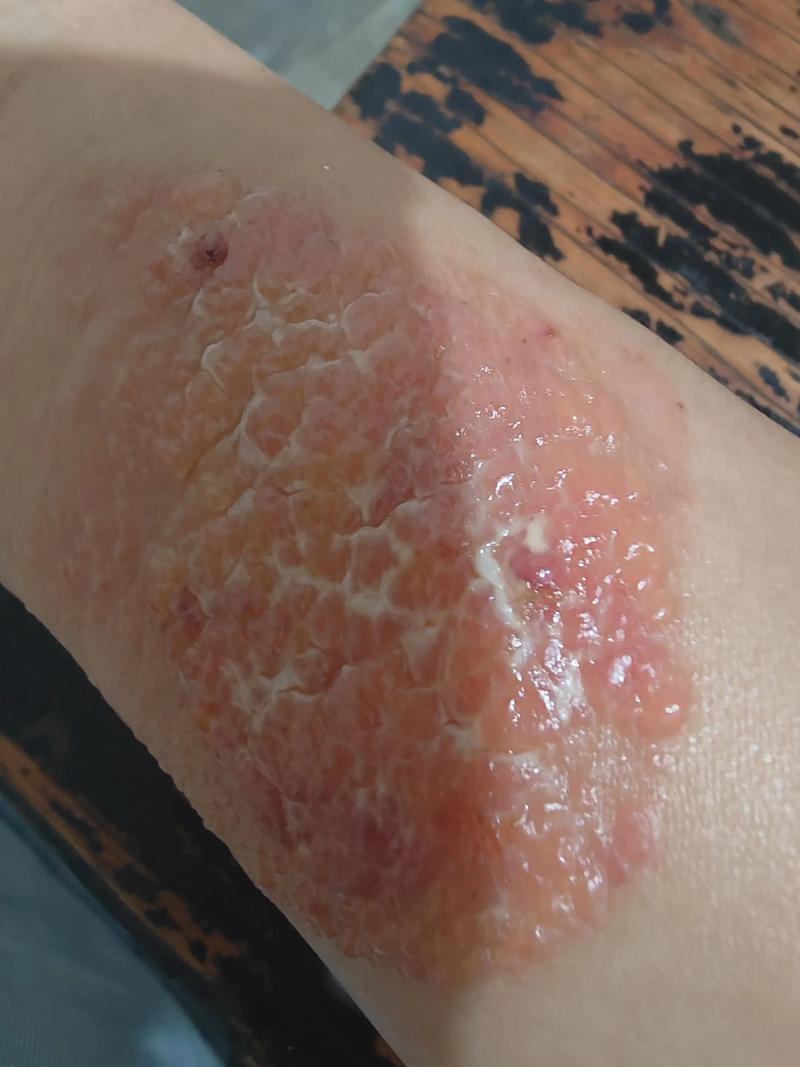 风湿贴膏药后火辣辣的